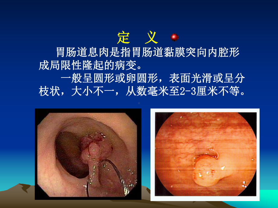 胃肠息肉医学课件-.ppt_第2页