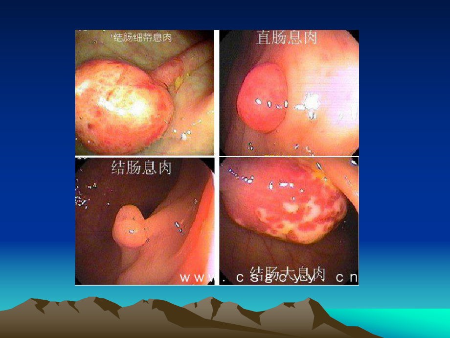 胃肠息肉医学课件-.ppt_第3页