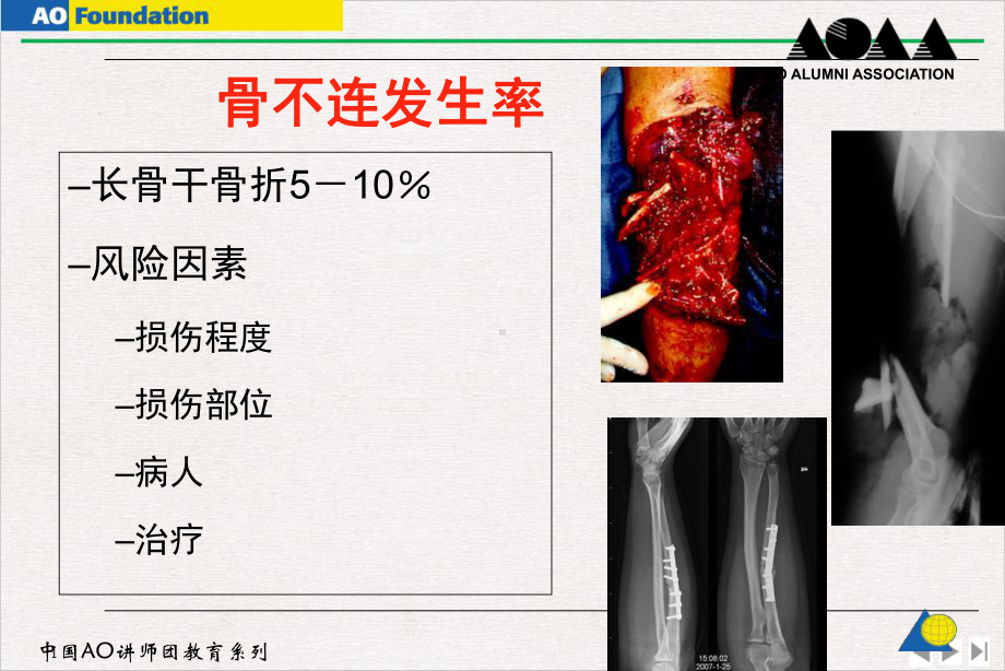 骨不连和骨延迟愈合优质推荐课件.pptx_第3页