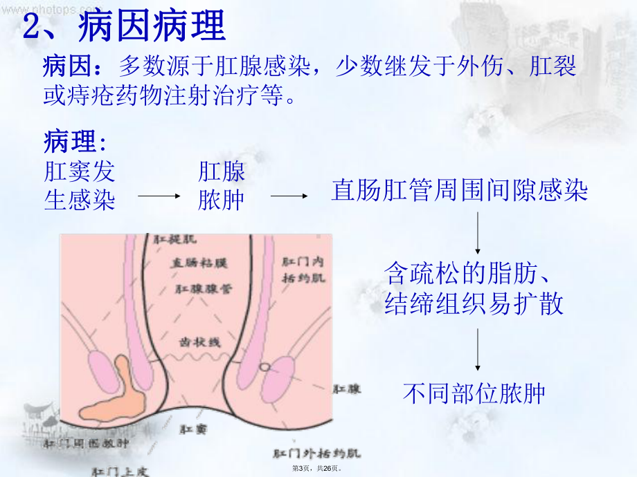 肛周脓肿护理查房资料课件.ppt_第3页