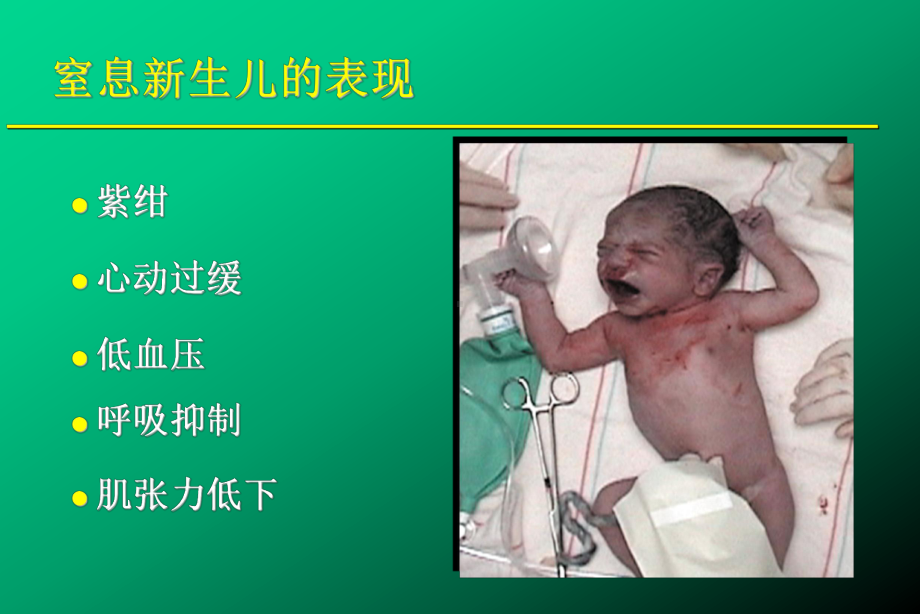 新生儿复苏概述课件.ppt_第2页