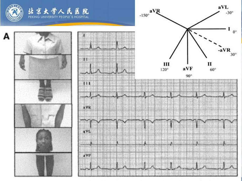 非常实用而被忽视的aVR导联-课件.ppt_第2页