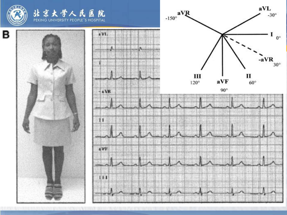 非常实用而被忽视的aVR导联-课件.ppt_第3页