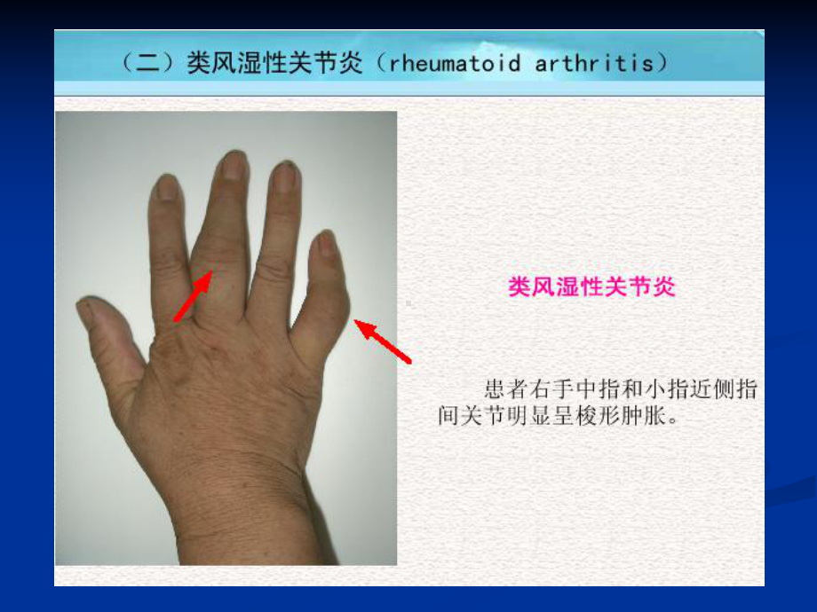 类风湿关节炎详解课件.ppt_第2页