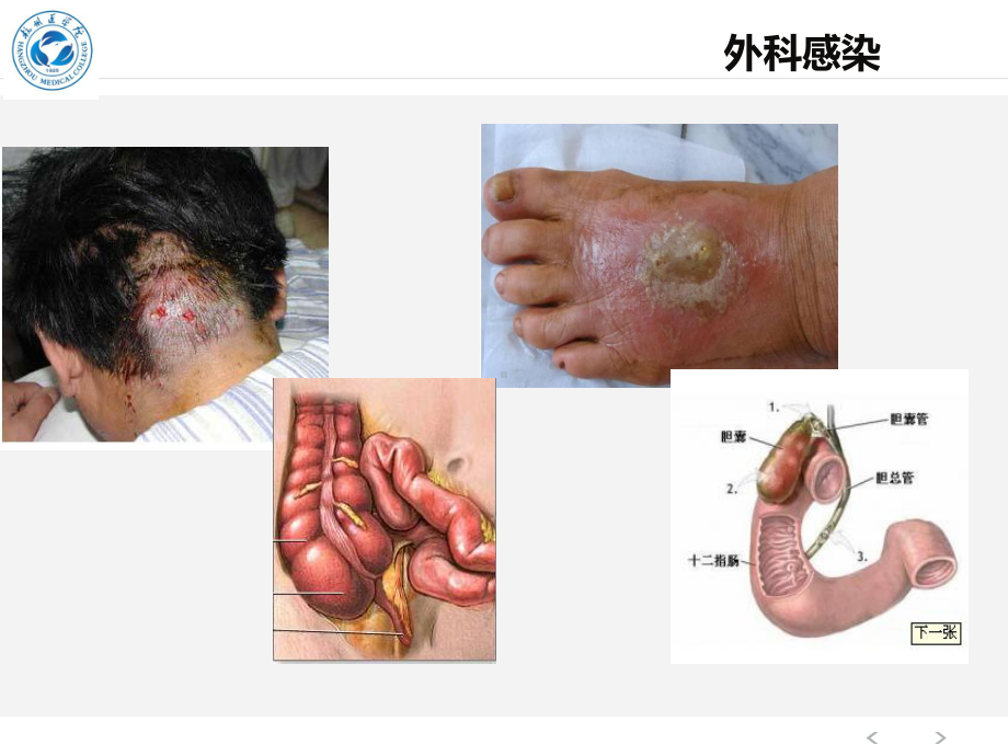 肿热痛和功能障碍是化脓性感染的五个典型症状病理基础就是充血课件.ppt_第2页