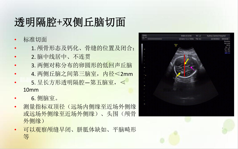 胎儿三维超声筛查标准切面示范课件.ppt_第2页