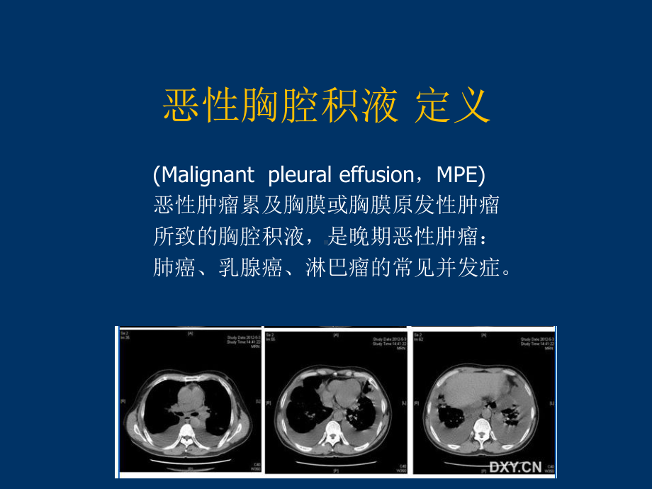 恶性浆膜腔积液概述课件.ppt_第3页