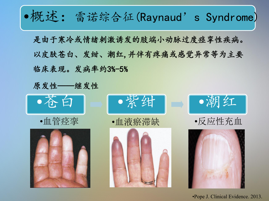 A型肉毒毒素治疗雷诺综合征初步临床研究课件.pptx_第3页