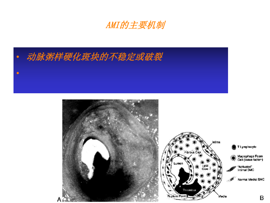 AMI的溶栓治疗课件.ppt_第2页