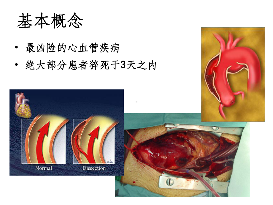 A型主动脉夹层的围术期处理课件.ppt_第2页