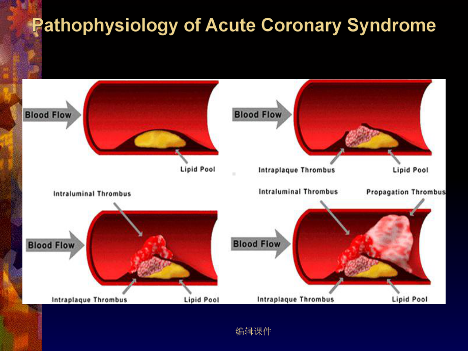 ACS是否应该早期介入治疗课件.ppt_第2页