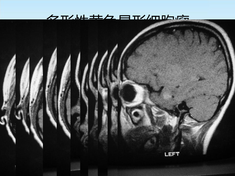 CNS疾病MRI诊断6课件.ppt_第3页