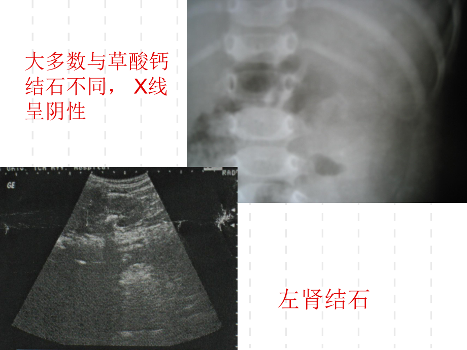 与食用受污染三鹿牌婴幼儿配方奶粉相关的婴幼儿泌尿系统结课件.ppt_第3页