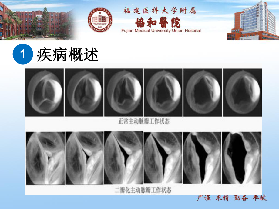 主动脉瓣二叶式畸形护理查房课件.ppt_第3页