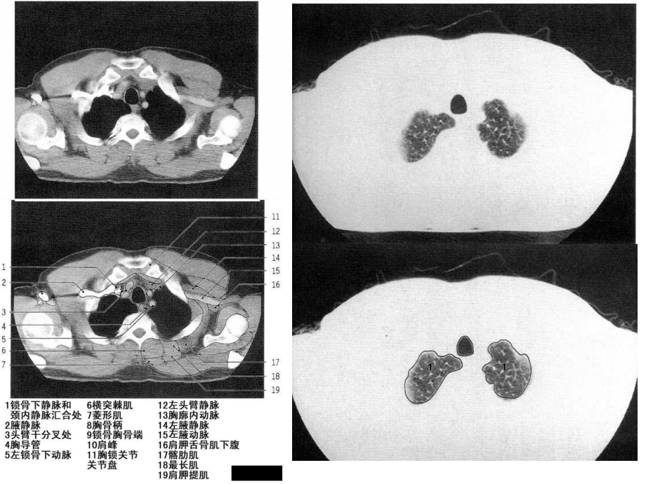 CT胸部正常解剖课件.ppt_第2页