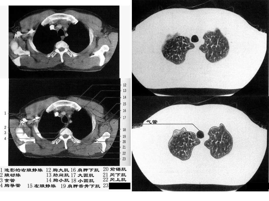 CT胸部正常解剖课件.ppt_第3页