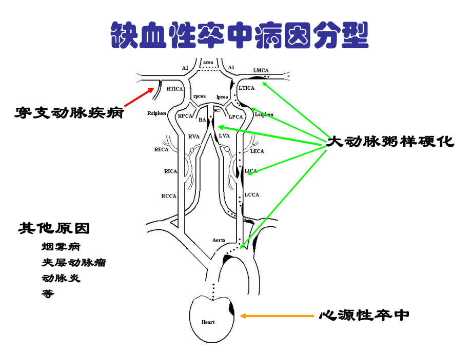 动脉粥样硬化性梗死分层病例课件.pptx_第2页