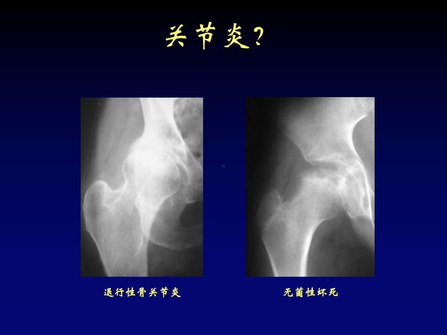 关节炎影像学评价课件.pptx_第3页