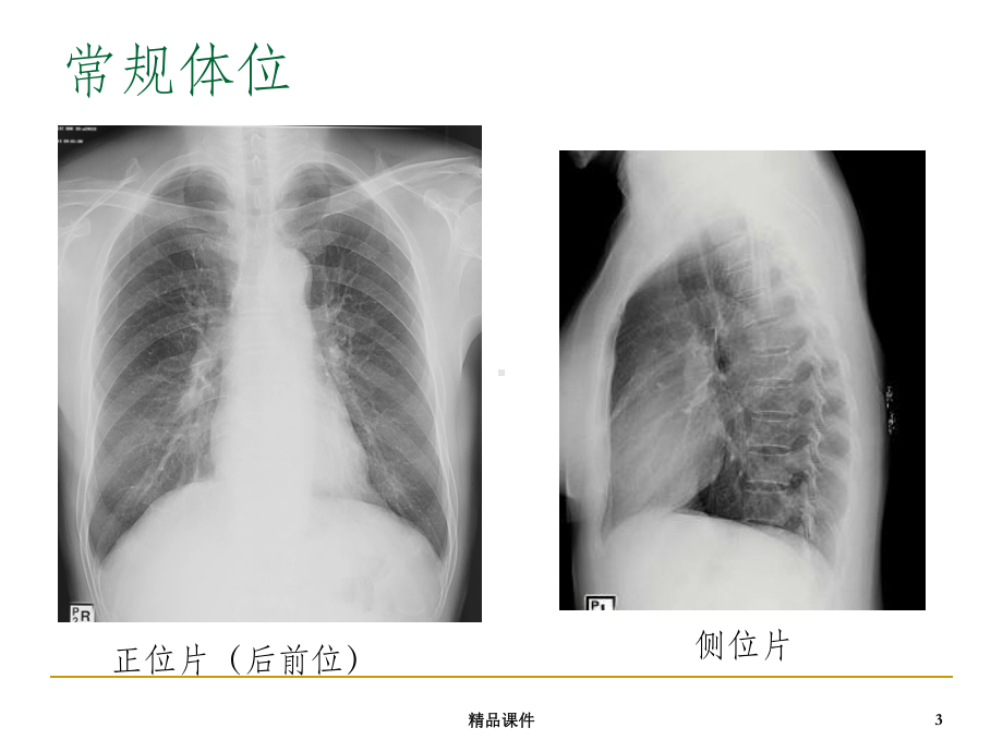 呼吸科影像学带教课件1.ppt_第3页