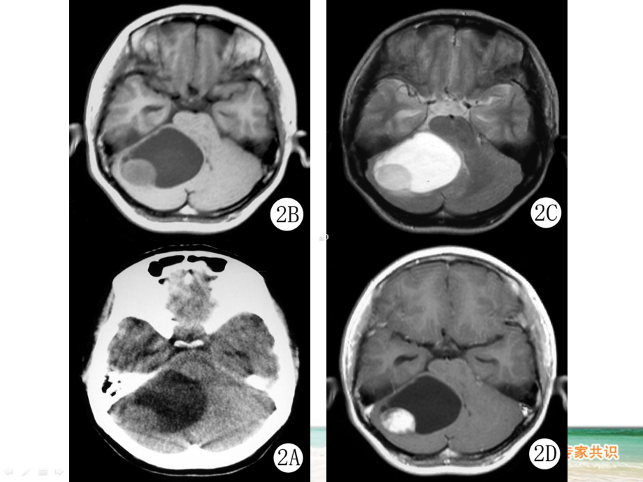 中枢神经系统血管母细胞瘤的影像学图像课件.ppt_第3页