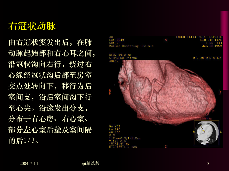 冠状动脉的解剖及CT表现课件.ppt_第3页