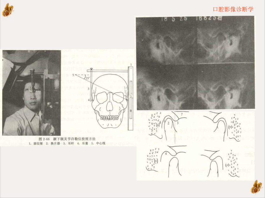 口腔颌面医学影像诊断学颞下颌关节疾病课件整理.ppt_第3页