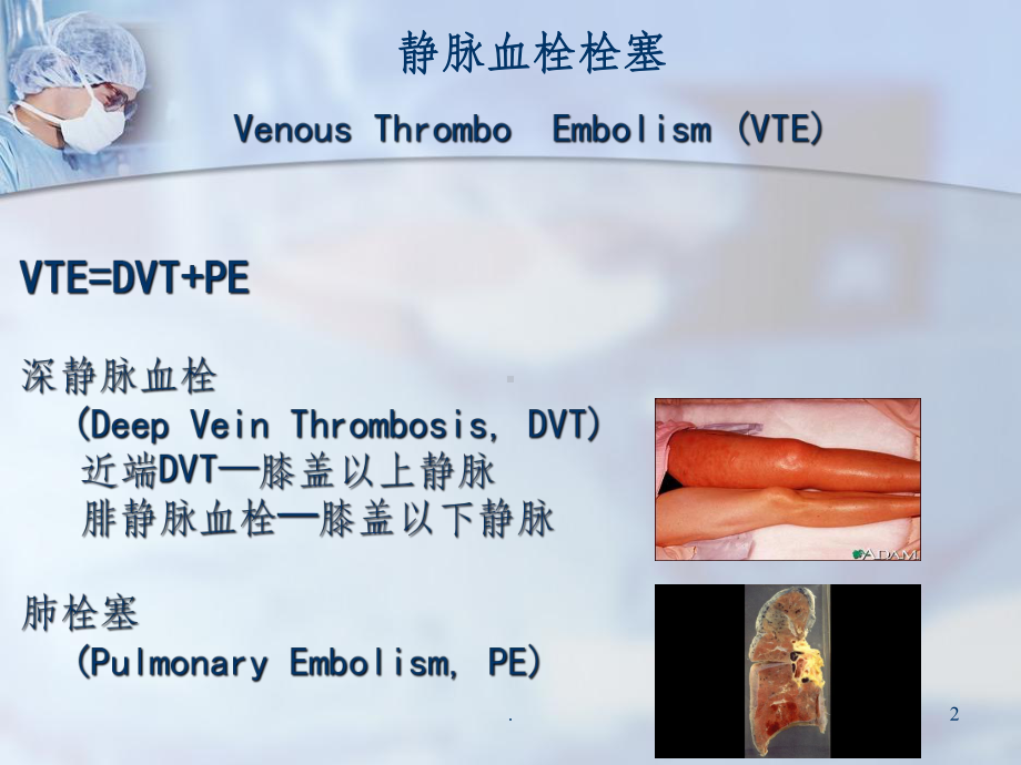 ICU深静脉血栓的预防课件.ppt_第2页