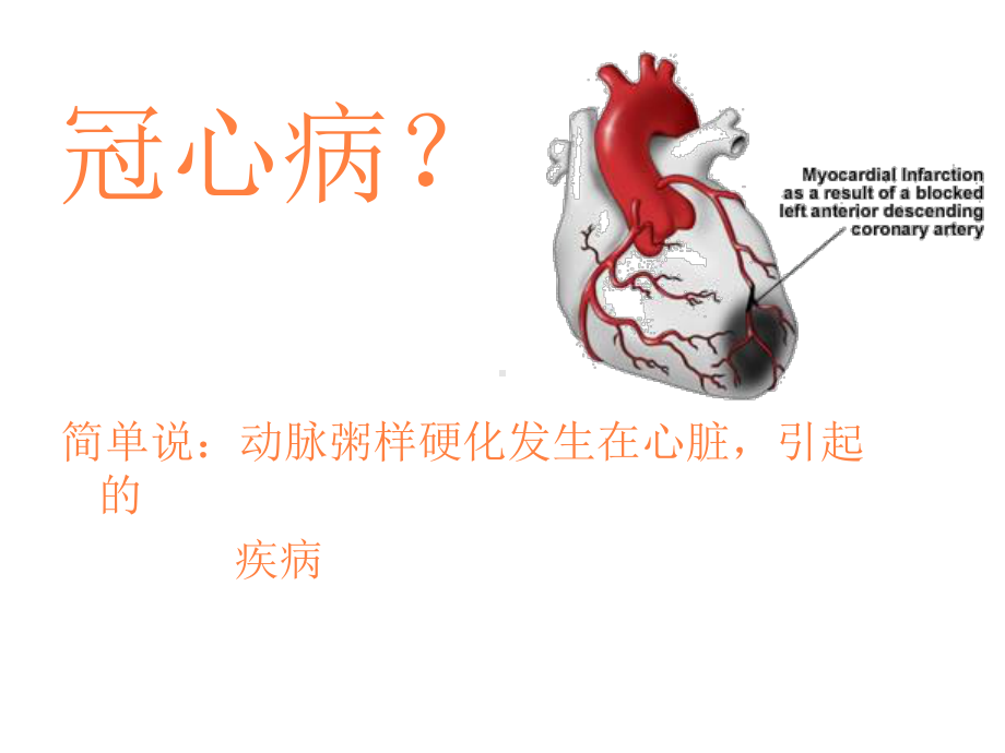 冠心病宣教课件.ppt_第2页