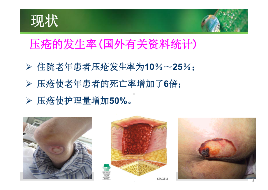 压疮的预防和护理课件.pptx_第3页