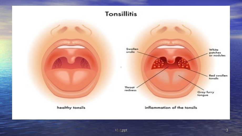 儿童急性扁桃体炎诊疗课件.ppt_第3页