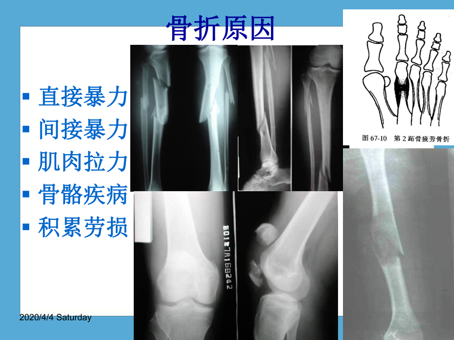 （人卫九版骨科）骨折概论课件.pptx_第3页