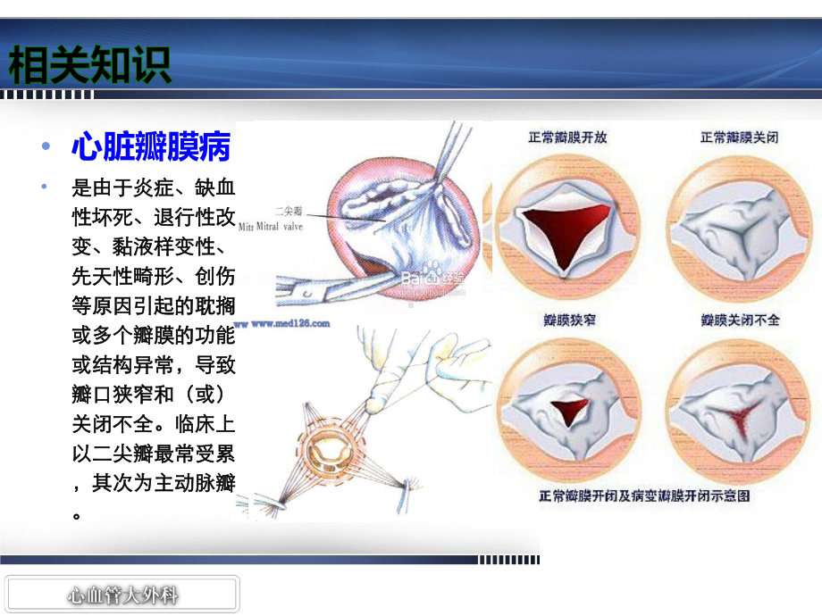 双瓣置换术护理查房课件.ppt_第3页