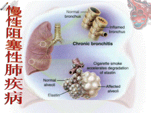 COPD慢性阻塞性肺疾病(同名180)课件.ppt