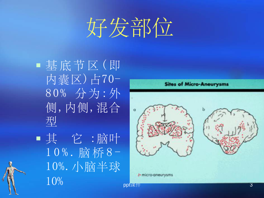 （大学课件）脑出血(Cerebral-Haemorrahge).ppt_第3页