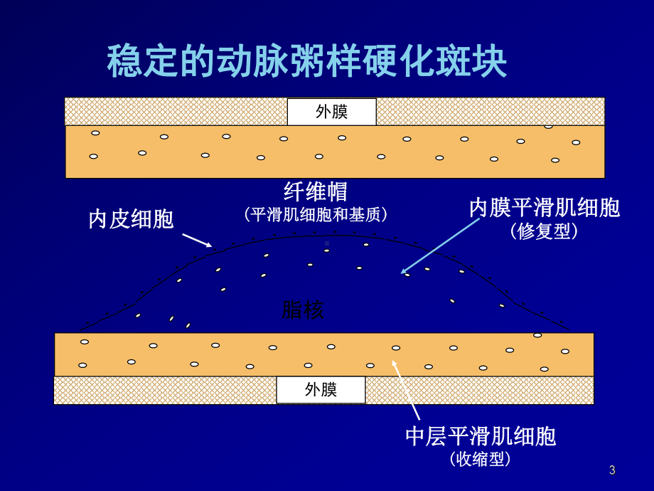 冠心病见习课件.ppt_第3页