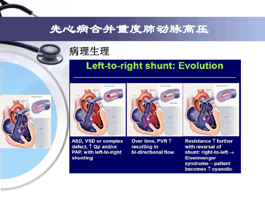 先心病并重度肺动脉高压治疗单中心经验课件.ppt_第3页