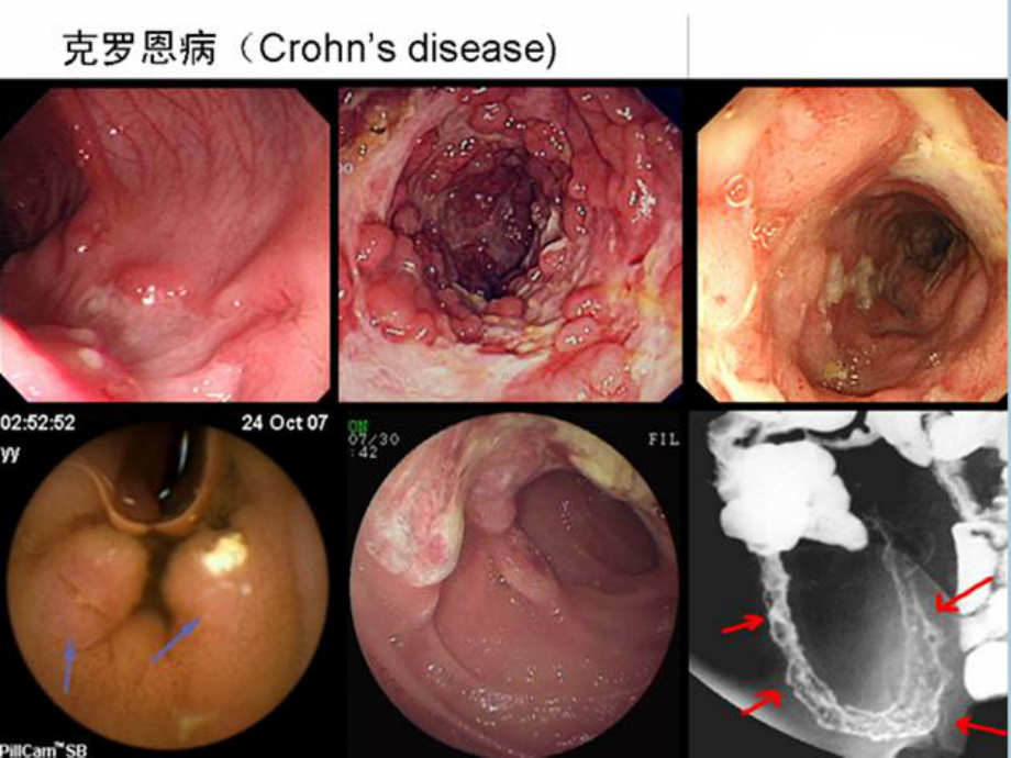 克罗恩病诊治护理课件.ppt_第3页