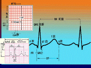 冠心病的心电图诊断及鉴别1课件.ppt