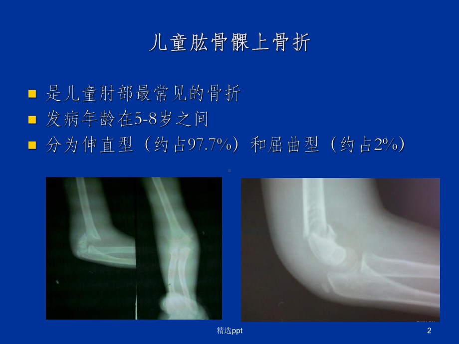 儿童肘关节创伤的诊断和治疗课件整理.ppt_第2页