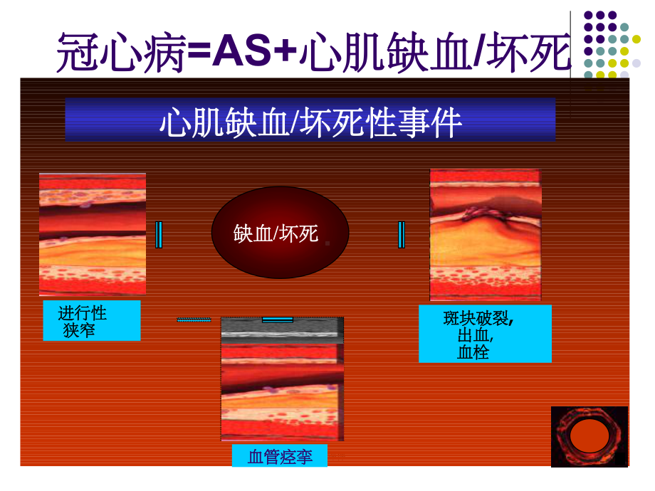 冠心病防治新进展课件.ppt_第2页