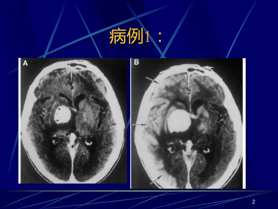 中枢神经系统淋巴瘤的影像学诊断课件.ppt_第2页