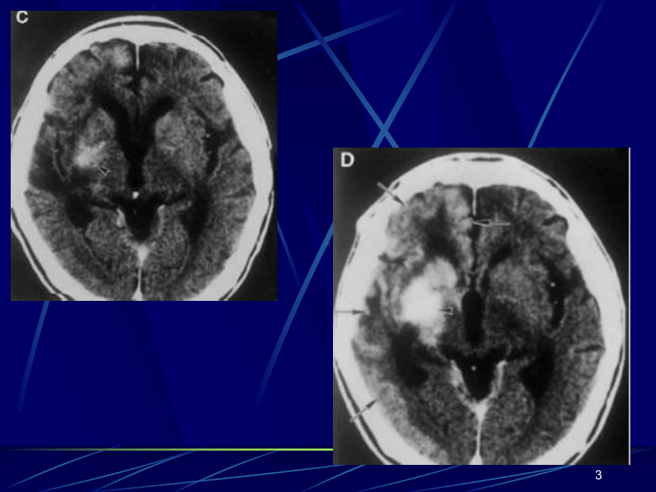 中枢神经系统淋巴瘤的影像学诊断课件.ppt_第3页