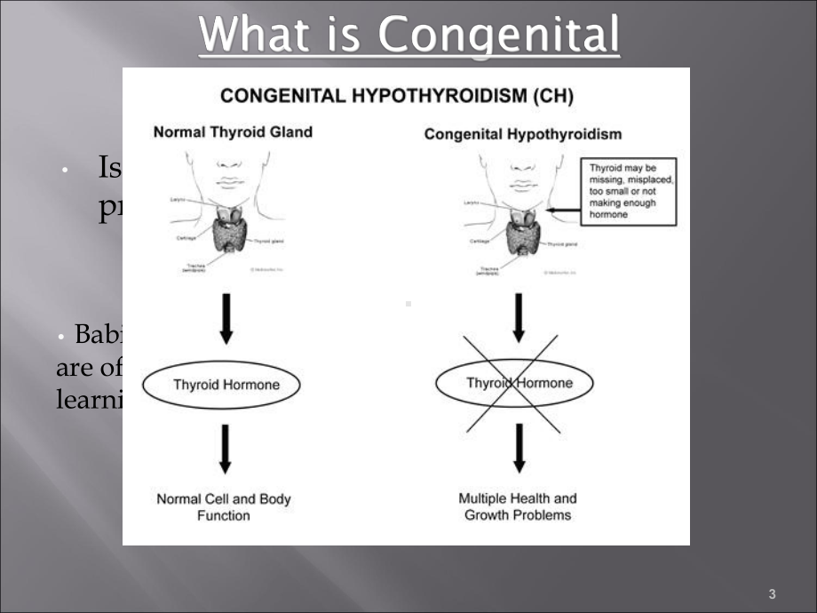 先天性甲状腺功能减退课件.ppt_第3页