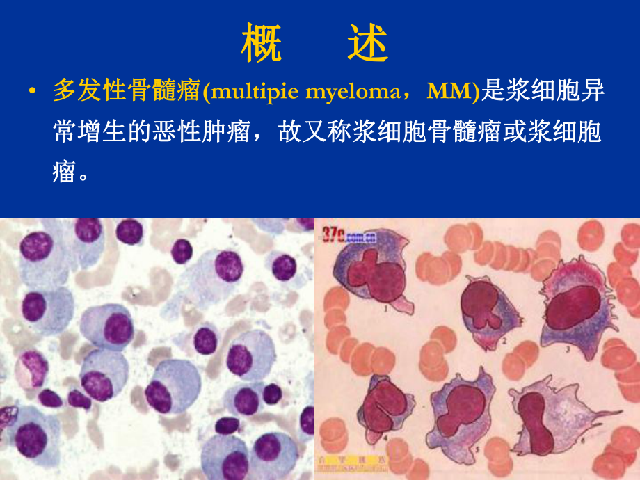 多发性骨髓瘤肾脏损害诊断和治疗课件.ppt_第2页