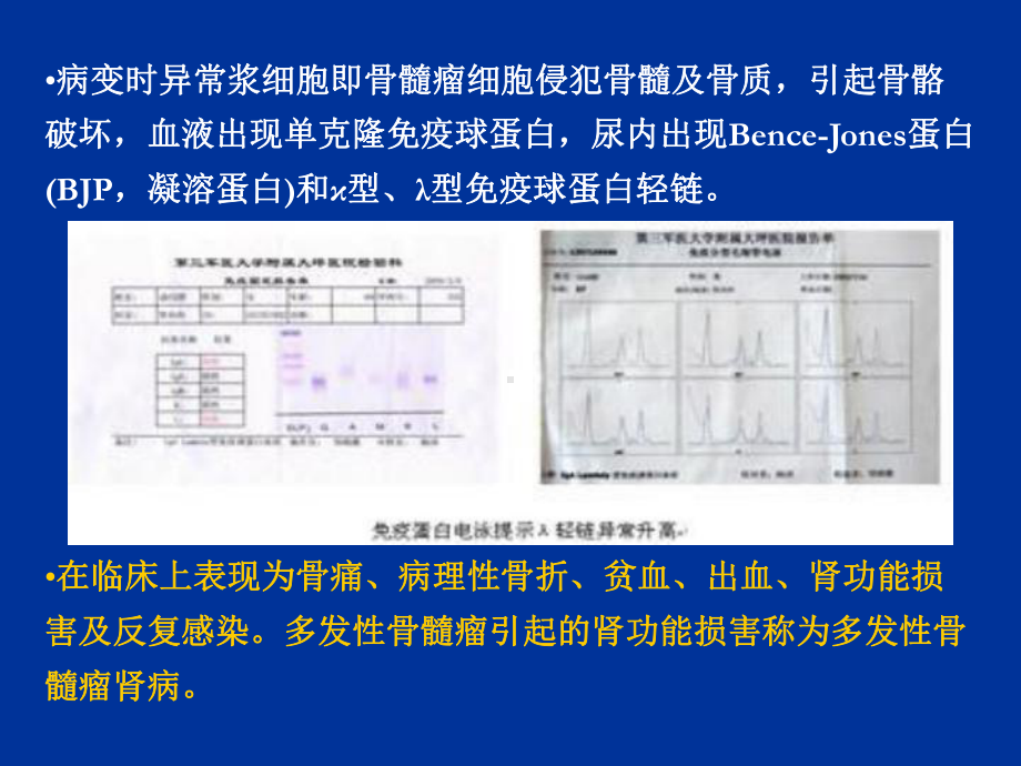 多发性骨髓瘤肾脏损害诊断和治疗课件.ppt_第3页