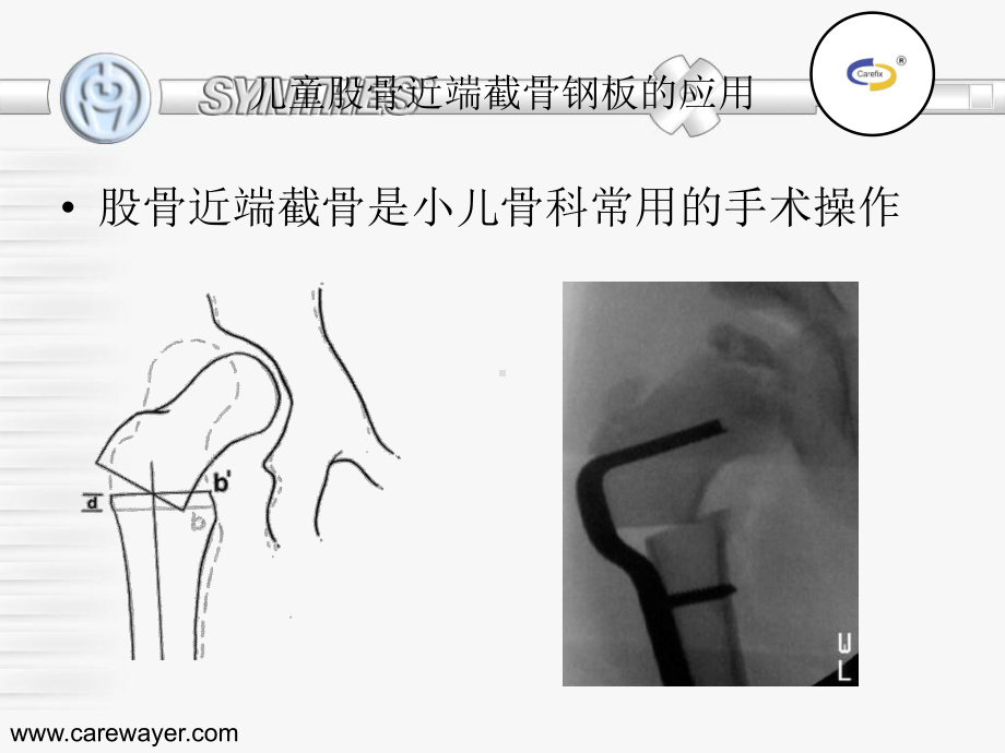 lcppediatric-plate-的临床应用课件.ppt_第2页