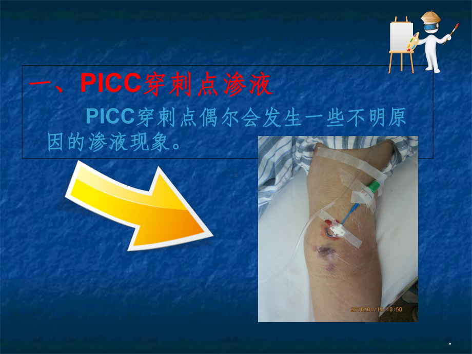 PICC穿刺点渗液与皮肤过敏的处理(同名468)课件.ppt_第2页