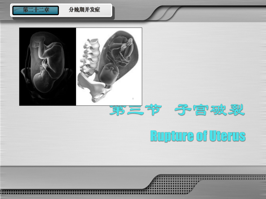 子宫破裂-Microsoft-PowerPoint-演示文稿-课件2.ppt_第2页