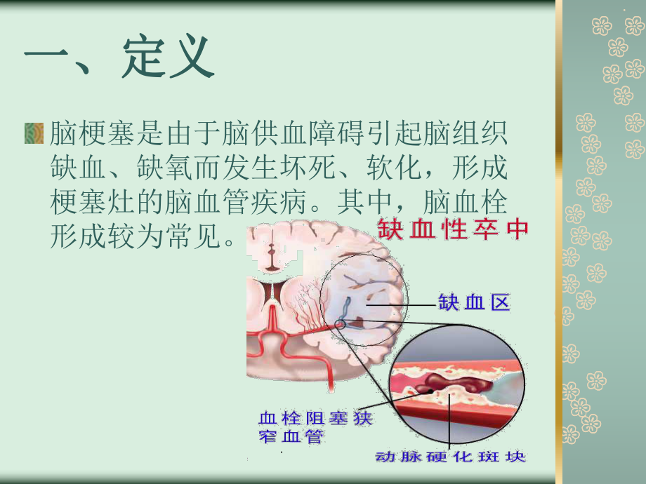 《脑梗塞的护理常规》课件.ppt_第2页