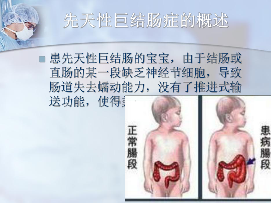 先天性巨结肠症的观察和护理课件.pptx_第3页